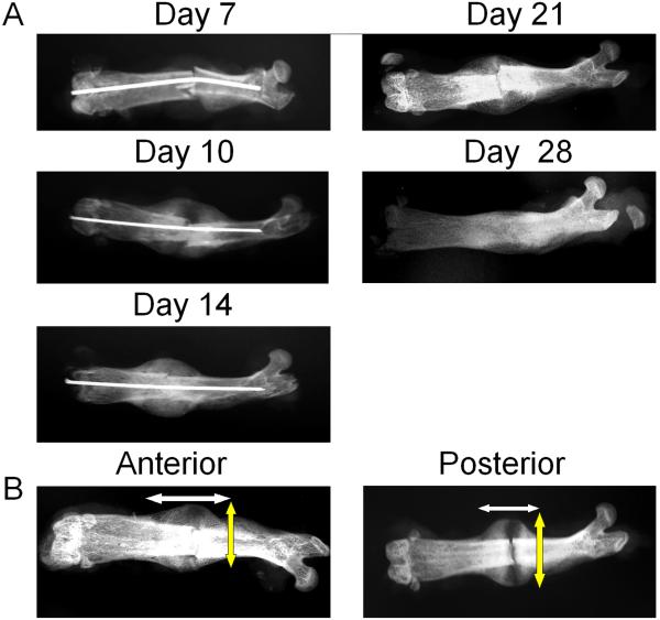 Bone Fracture - Evaluation and Treatment